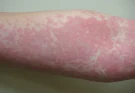 What’s really causing your hives? Uncover these unexpected triggers