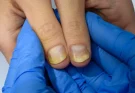 Doctor Reveals 7 Health Issues Hidden in Your Nails
